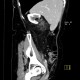 Retroperitoneal lipoma, large: CT - Computed tomography